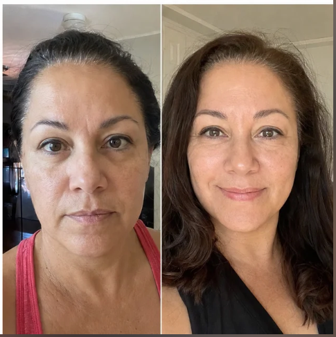 Customer before and after wearing the clear face-lifting strips.